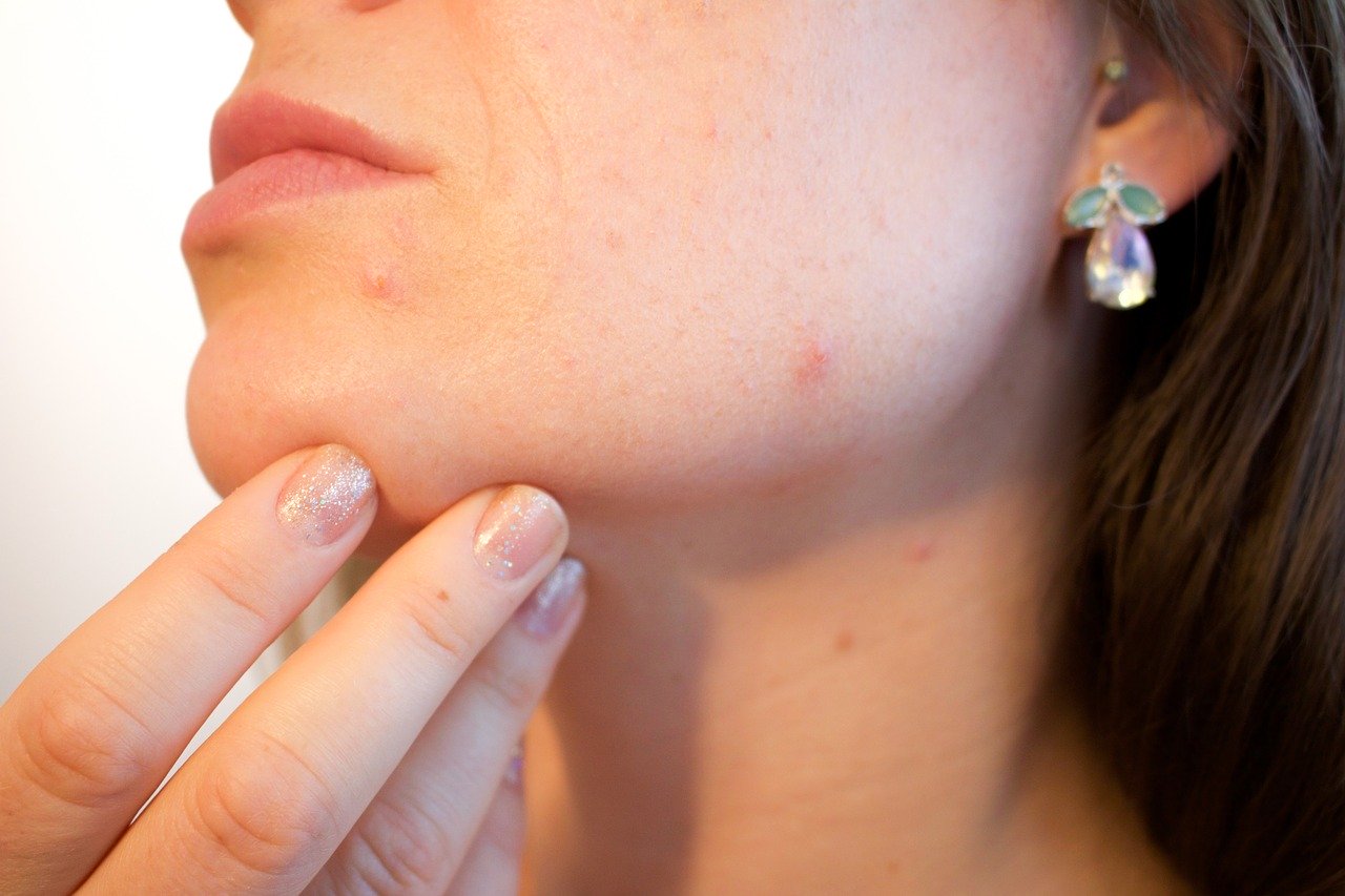 Acupuncture for acne works as well as medication Jessica Kennedy